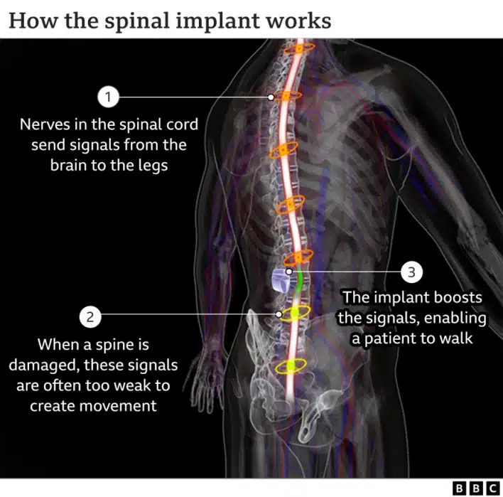 123131391 spinal implant 640 2x nc