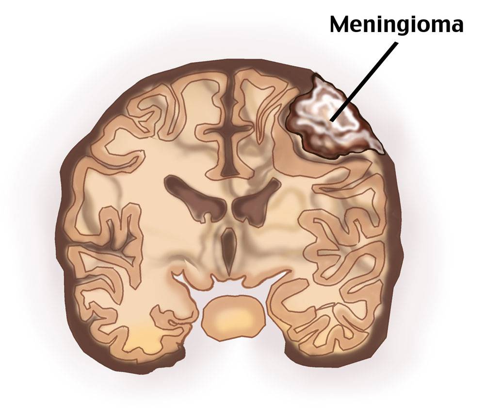 meningioma