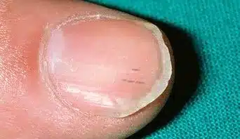 1nail