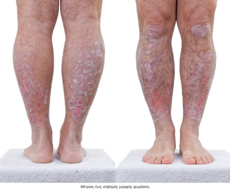 extended plaque psoriasis on the legs