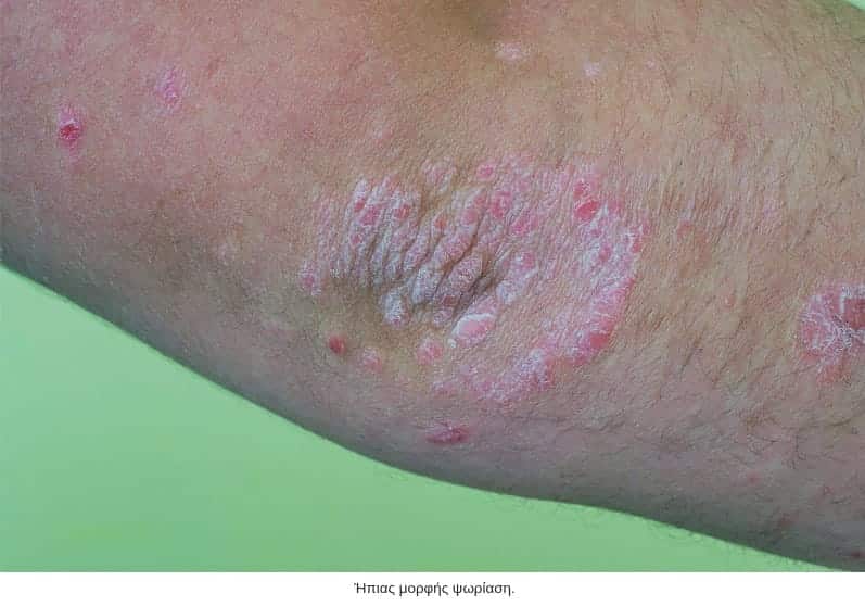 mild psoriasis