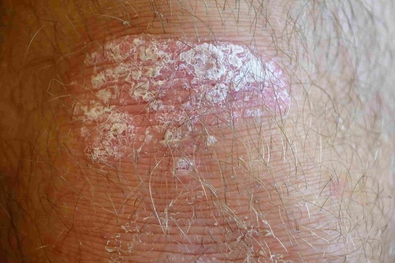 plaque psoriasis