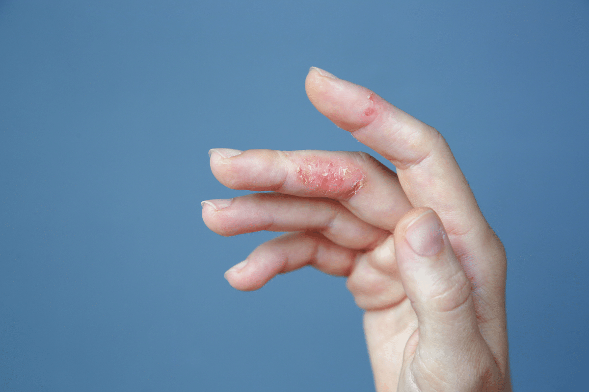 hand eczema