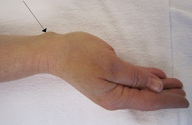 ganglion